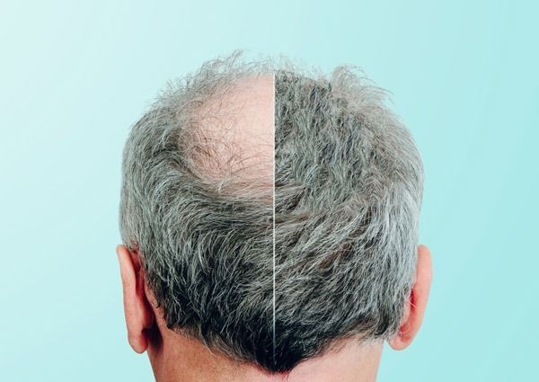 minoxidil