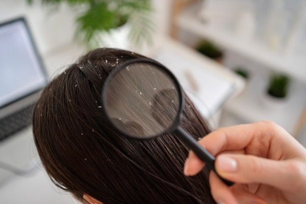 causas da caspa - Mulher consulta dermatologista para exame de caspa