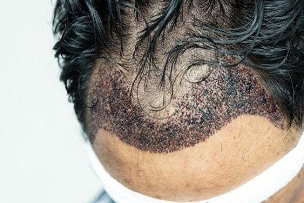 Transplante de cabelo infectado