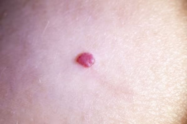 hemangioma capilar na pele de um bebê