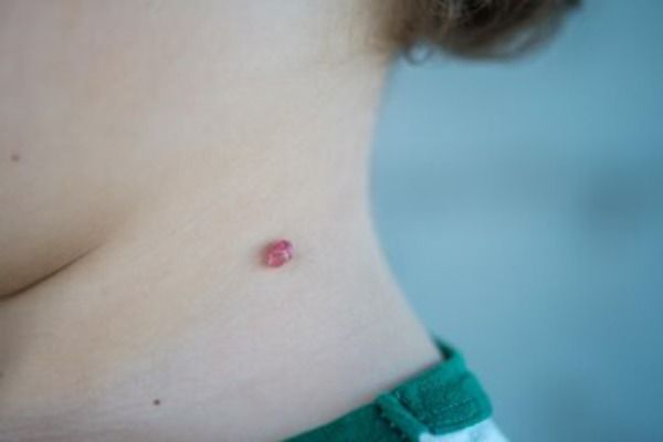 Hemangioma capilar - Hemangioma capilar no pescoço de uma criança 