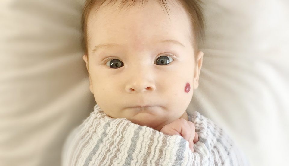 hemangioma capilar: o que é e como removê-lo - bebê deitado em uma cama com uma mancha causada por um hemangioma