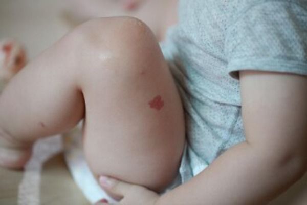 Hemangioma capilar - Seção inferior das pernas da criança na cama