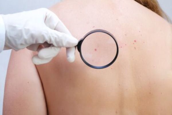 Foto o médico examina os crescimentos na pele de um adulto com uma lupa, diagnóstico de câncer de pele. 
