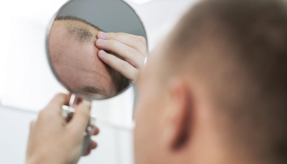 transplante capilar FUT - Um homem se olha no espelho e vê os danos causados pela alopecia.