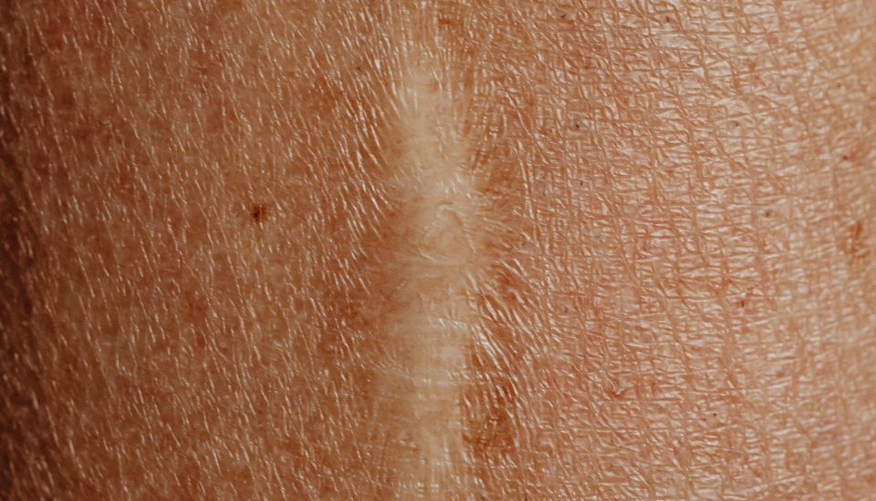 enxerto de cabelo em cicatrizes