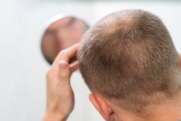 idade para um implante capilar - Homem adulto careca se olha no espelho