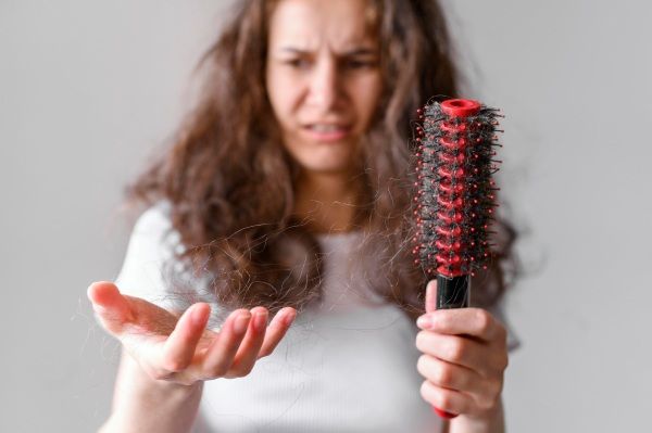 queda de cabelo pós-Covid - Fêmea com queda de cabelo pós-Covid