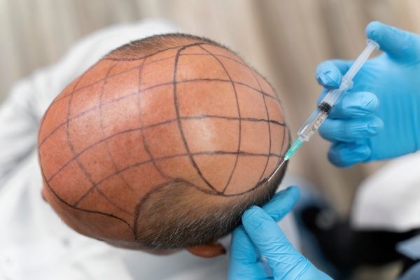 Homem recebendo anestesia antes do implante capilar