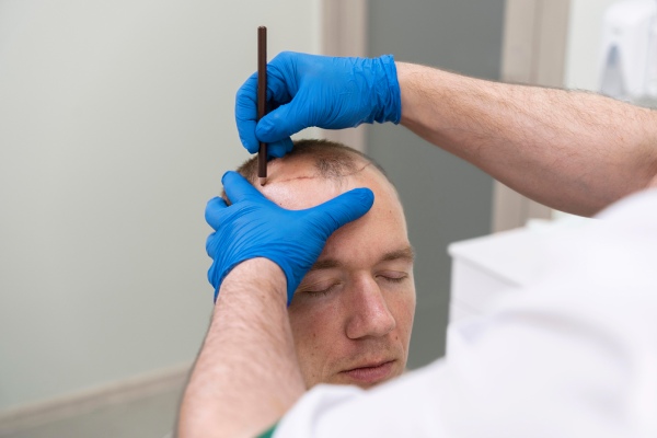 técnicas de transplante capilar - Paciente com certo grau de calvície é submetido a transplante capilar