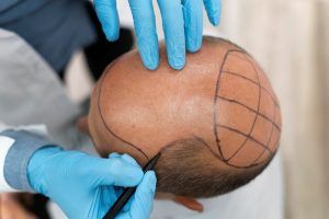 Macho passando por um processo de extração da unidade folicular