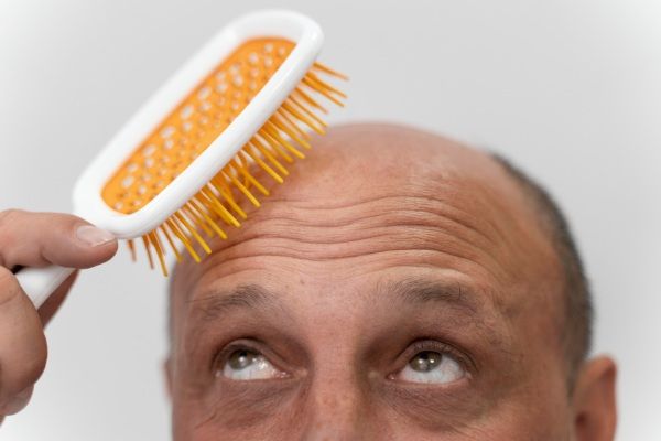 Homem penteando o primeiro cabelo após um implante capilar
