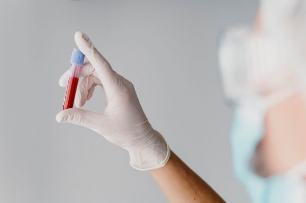 Médico segurando uma amostra de sangue, um dos testes para diagnosticar a alopecia