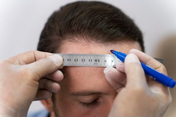 Homem em preparativos médicos para seu implante capilar 