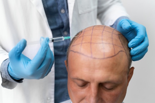 Homem corajoso passando por um processo de extração de unidade folicular