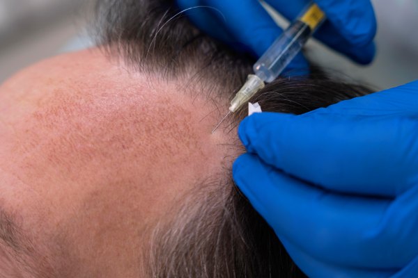 Preparação para o procedimento de transplante capilar 