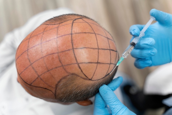 Transplante capilar FUE - Homem sendo anestesiado antes de seu transplante capilar