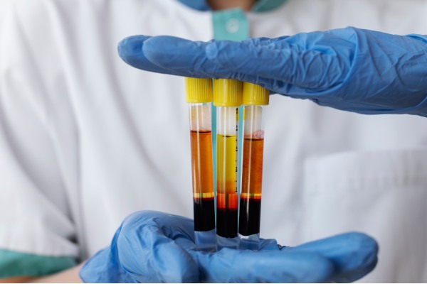 tratamentos capilares - técnico de laboratório mostrando tubos de ensaio com sangue separado em seus componentes após passar pela centrífuga.