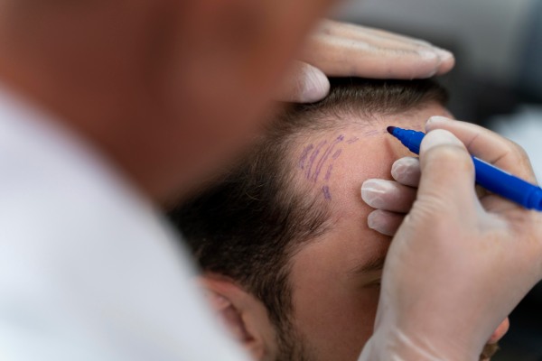 o implante capilar é uma solução popular e eficaz para calvície avançada ou perda irreversível de cabelo, pois fios de áreas densas são transplantados