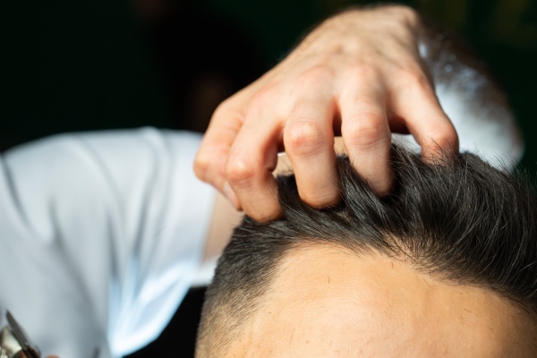 transplante de cabelo - homem passando os dedos sobre a cabeça de outro homem com sinais de alopecia na linha do cabelo