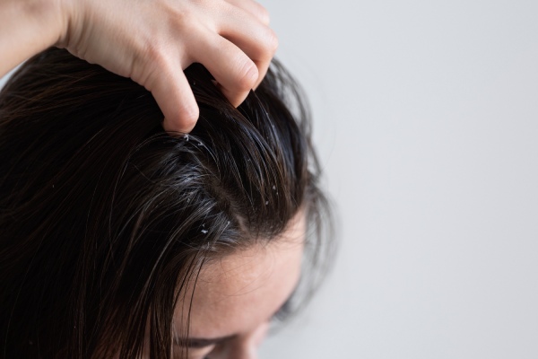 como tratar dermatite seborréica - mulher passando os dedos pelo cabelo