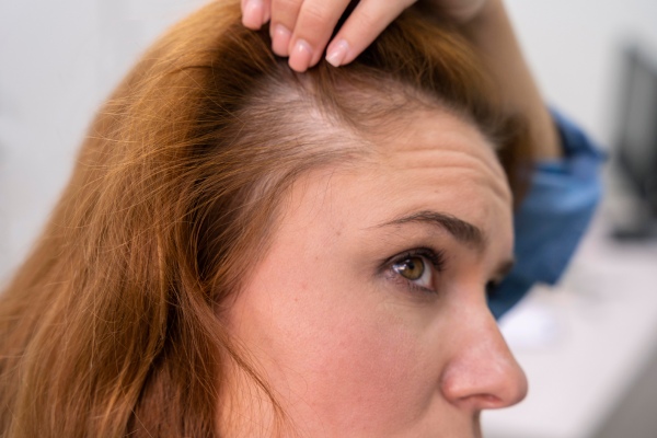 alopecia de tração - mulher com alopecia de tração leve