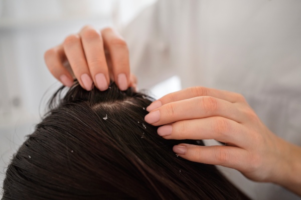 como acabar com a caspa - especialista examinando o cabelo de uma mulher com caspa