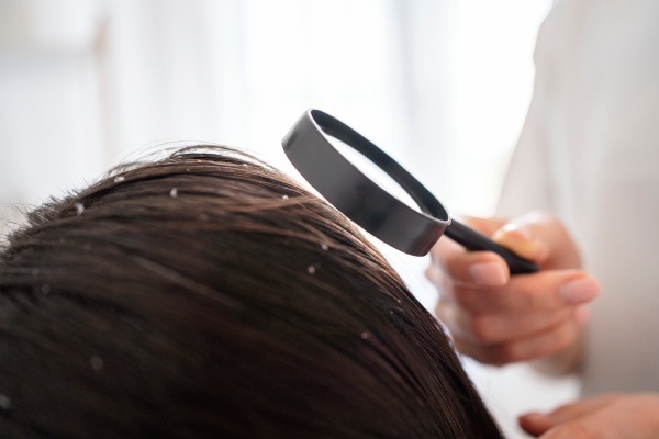 doenças capilares - Um dermatologista examina o cabelo de um paciente com caspa com uma lupa