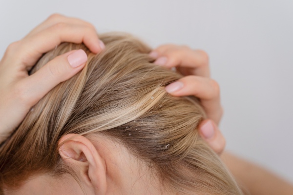 mulher com primeiros sintomas de dermatite seborreica