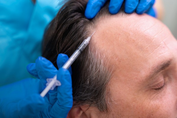 implante capilar antes e depois - Homem adulto recebendo tratamento com PRP