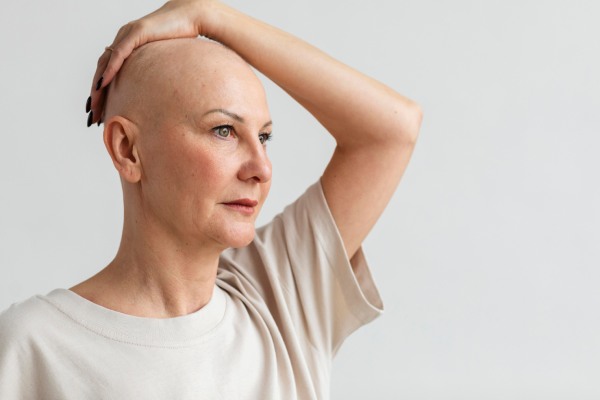 Mulher com alopecia
