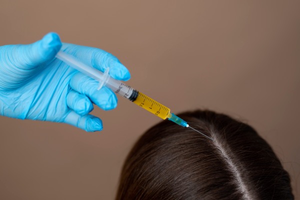 injeção de plasma no couro cabeludo